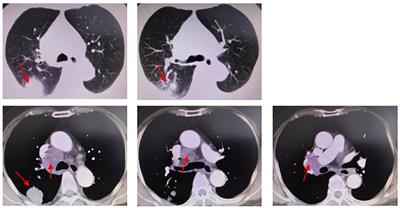 Case report: Successful treatment of advanced pulmonary sarcomatoid carcinoma with BUBIB-ALK rearrangement and KRAS G12C mutation by sintilimab combined with anlotinib
